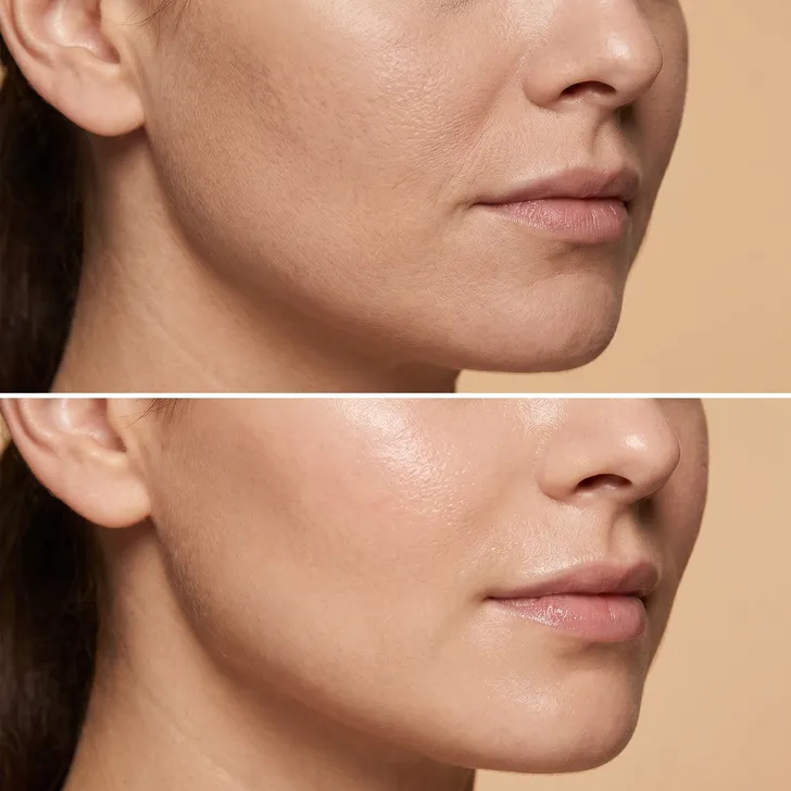 Aquafacial before and after — refined pores