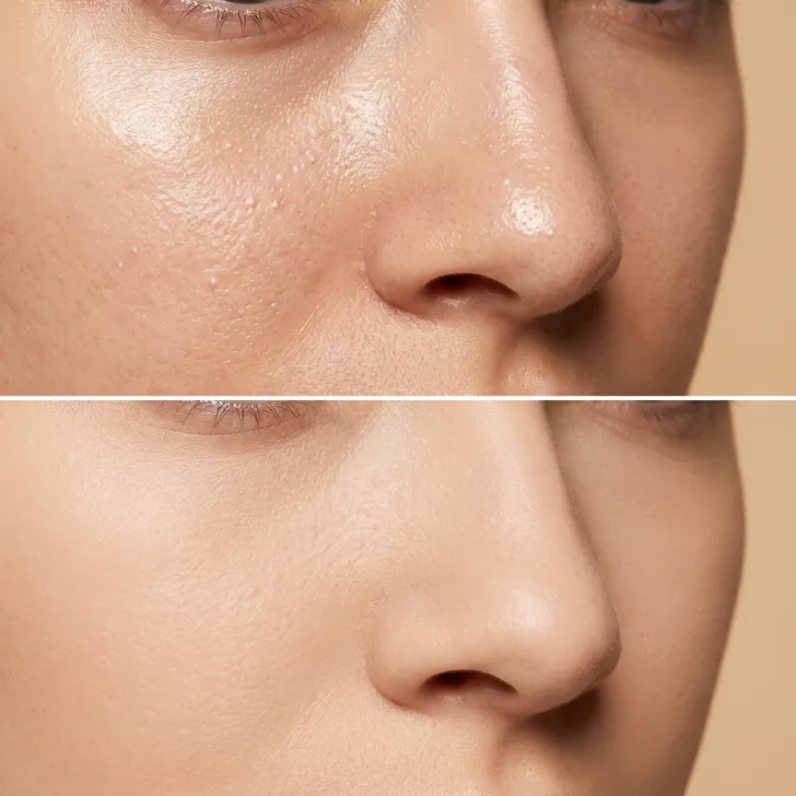 Aquafacial before and after — clear skin