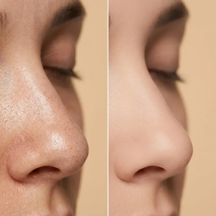 Before/After Comparison – Pores & Congested Zone