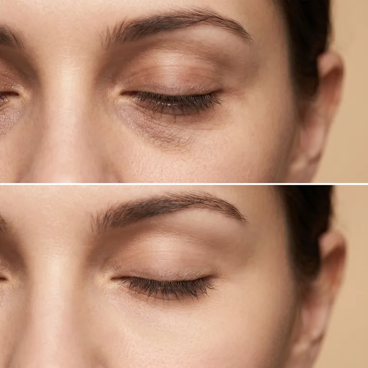 Before/After Comparison – Eye Area