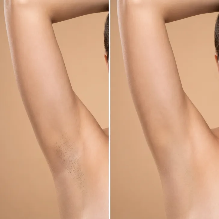 Before/After comparison — underarm waxing