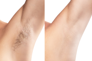 Armpit before after waxing
