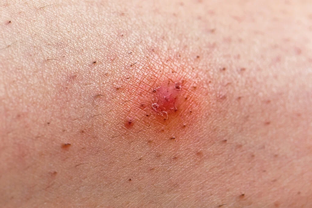 Ingrown hair in the intimate area