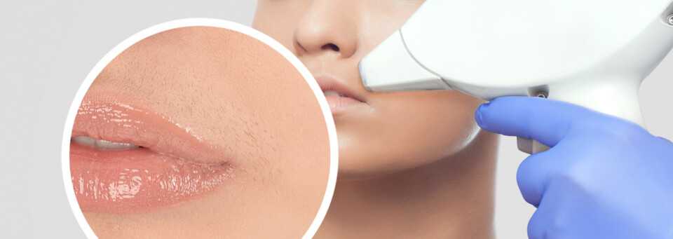 laser hair removal on the face (upper lip)